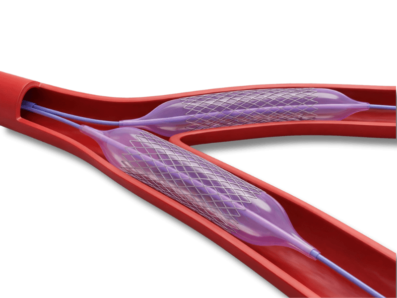 Ilustração: Angioplastia